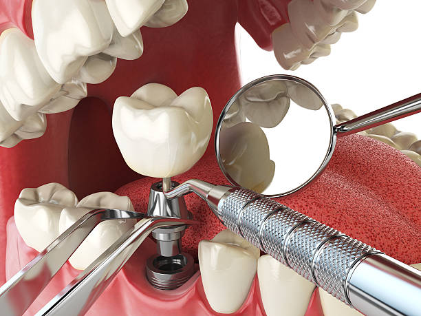 Best Emergency Wisdom Teeth Removal in Rockwall, TX